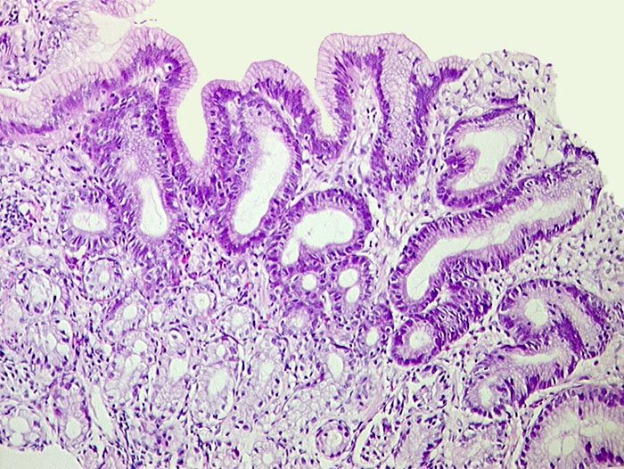 Low Grade Intraepitheliale Neoplasie Darm www.pathorama.ch