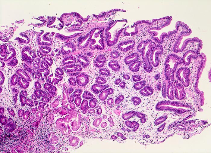 Tubuläres Adenom Mit Geringgradiger Intraepithelialer Neoplasie